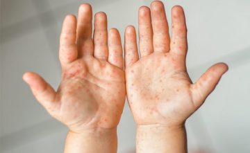 ما هي أعراض متلازمة اليد والقدم والفم؟