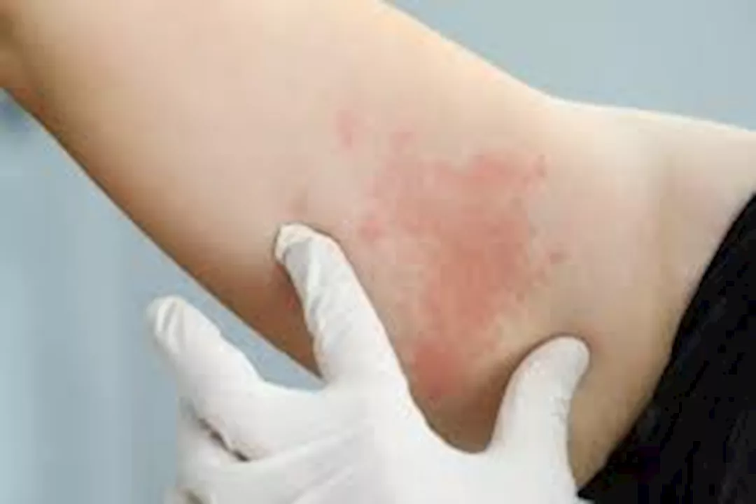 طرق طبيعية للوقاية من حبوب الإبط
