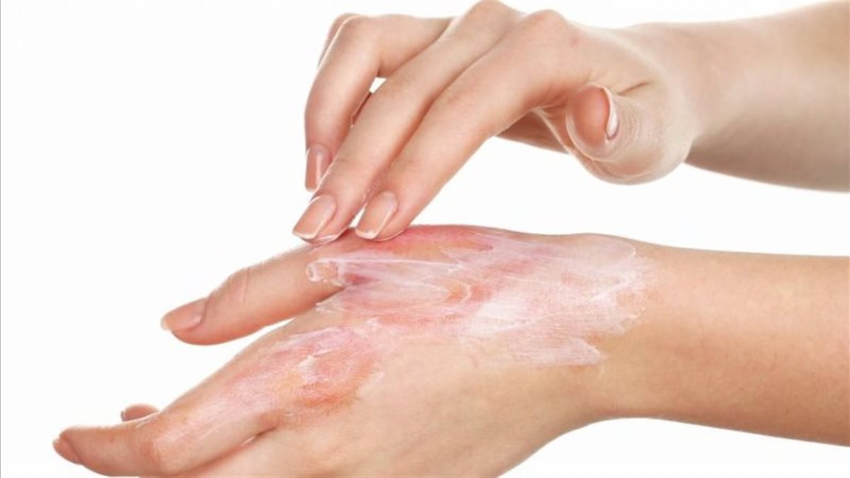 5 طرق سريعة لعلاج الحروق وكيفية التفرقة بين أنواعه