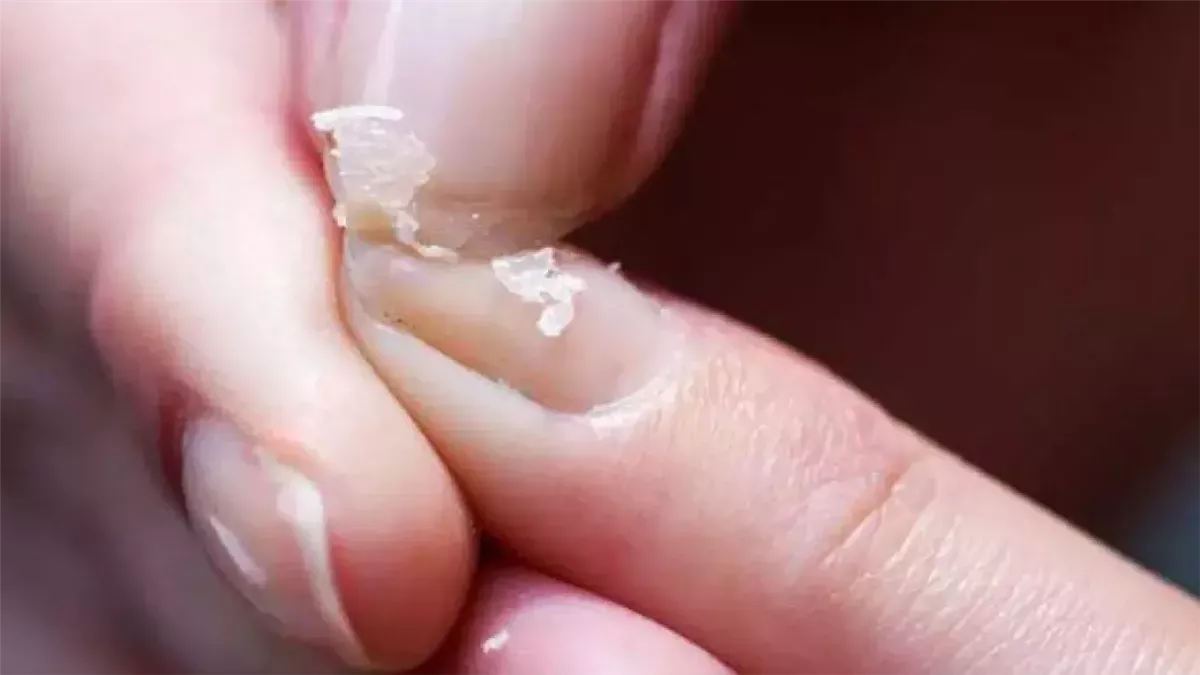 أبرزها هشاشة العظام.. تعرف على أعراض نقص الكالسيوم الصحية والنفسية