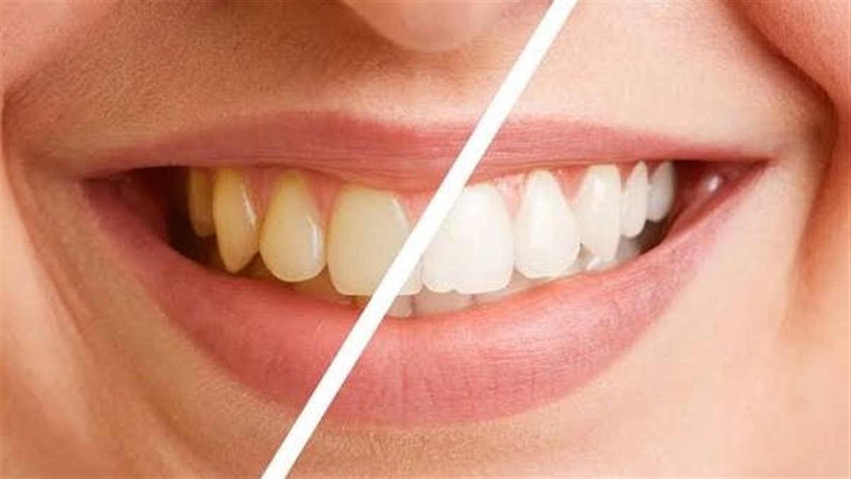 بدون طبيب.. 3 طرق منزليه للتخلص من اصفرار الأسنان بسهولة