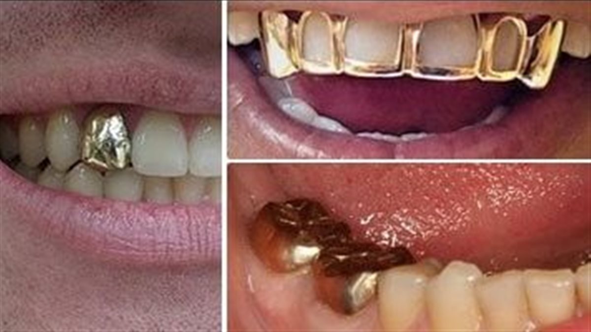 تفسير رؤية تركيب أسنان ذهب لابن سيرين.. زواج سعيد