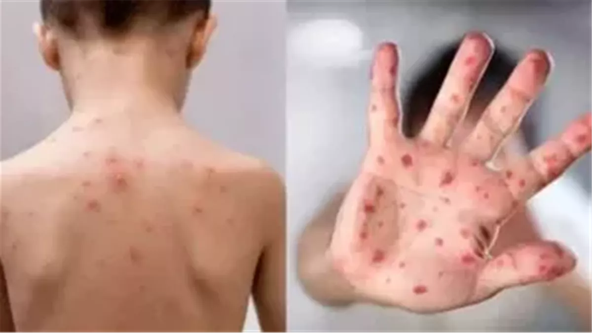 بعد ظهور إصابات بالجديري المائي في مدرسة بالمنوفية.. إليك الأعراض وطرق الوقاية