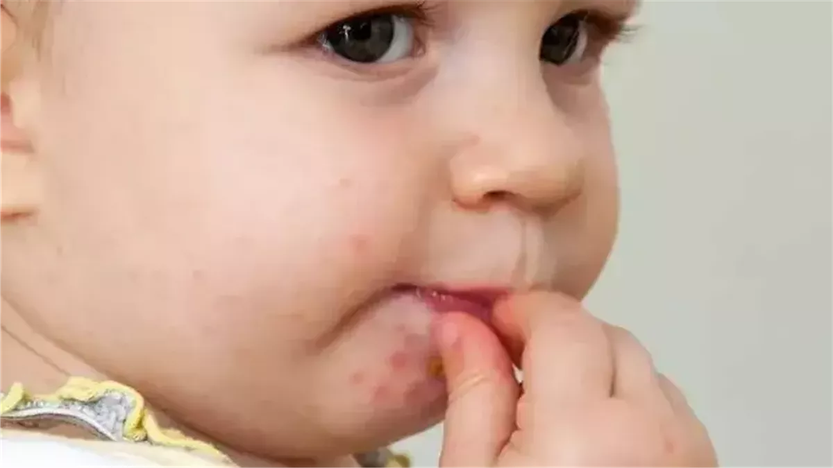 ما هو فيروس Hfmd المنتشر بين الأطفال؟ «طلاب المدارس أبرز المصابين»