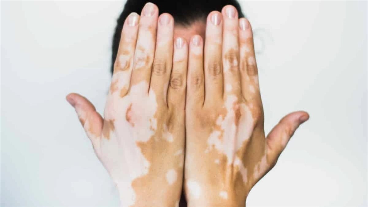 الأعراض والأسباب.. كل ما تريد معرفته عن مرض البهاق