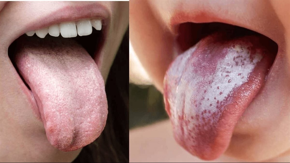 كل ما تريد معرفته عن داء القلاع أو مبيضات اللسان وأعراضه