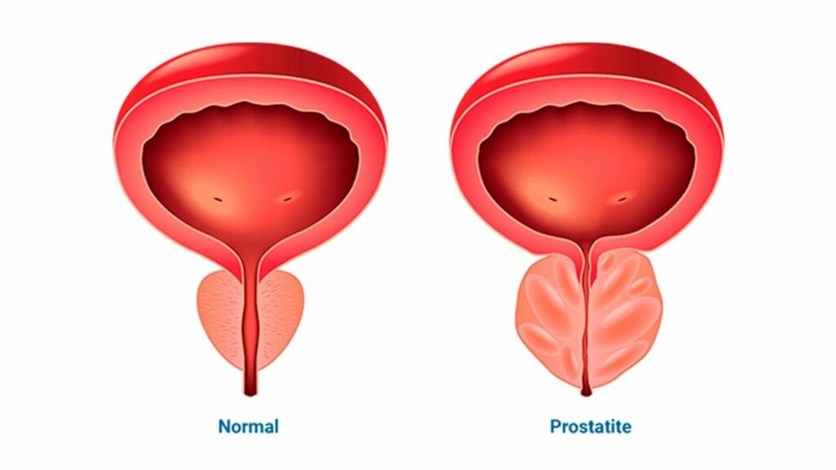 تعرف على أعراض وأسباب التهاب المثانة وعلاقتها بعسر البول