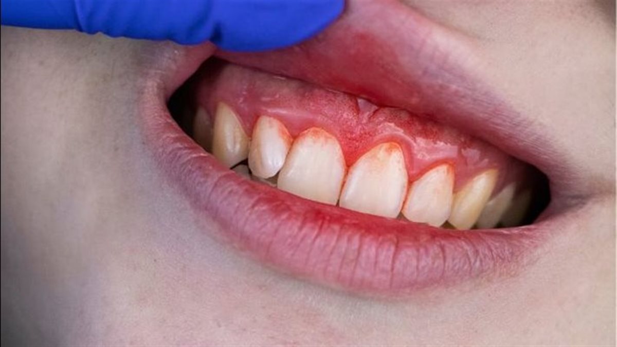 8 إرشادات صحية لتجنب نزيف اللثة ” تعرف عليها “