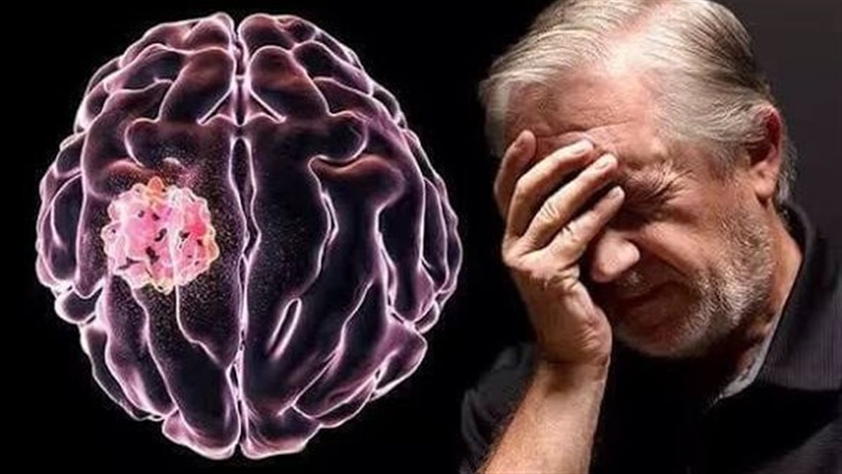 اكتشف مبكراً .. ما هي سرطان أعراض الدماغ " تفاصيل "
