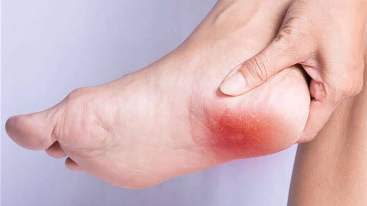 الشوكة العظمية.. تعرف على أبرز الأعراض وأسبابها