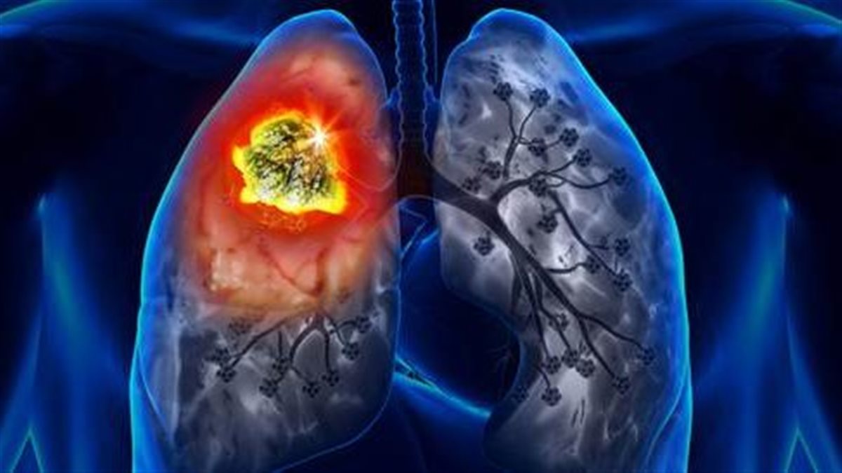 حملة وطنية للكشف المبكر عن سرطان الرئة للمواطنين فوق 18 عامًا