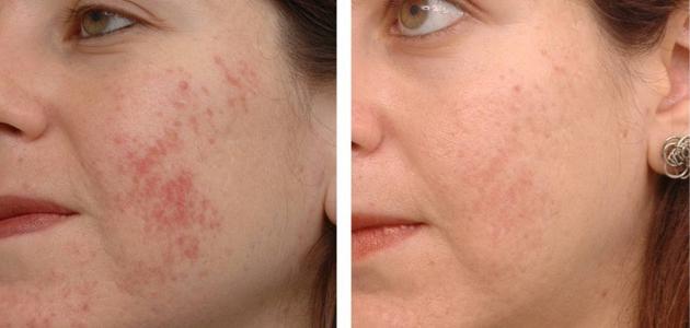 قبل عيد الفطر.. طرق بسيطة لعلاج آثار حب الشباب وتوحيد لون البشرة