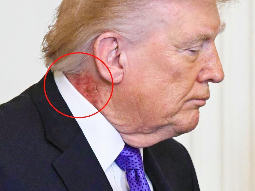 «جينات جيدة أم شمس حارقة؟».. الحقيقة وراء طفح ترامب الجلدي