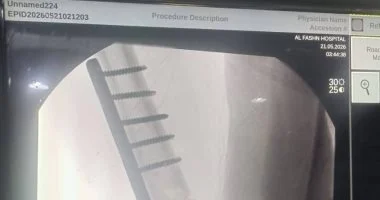 نجاح جراحة دقيقة لتثبيت كسر بالفخذ لطفل بمستشفى الفشن ببنى سويف
